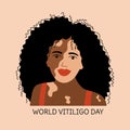 Vitiligo. Smiling girl with skin problems. World vitiligo day. Skin disease. Accepting oneself. Self love. Woman with curly black