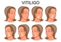Vitiligo treatment. before and after