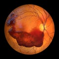 Vitreous hemorrhage as observed during ophthalmoscopy, 3D illustration Royalty Free Stock Photo