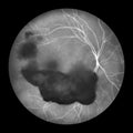 Vitreous hemorrhage as observed during ophthalmoscopy, illustration