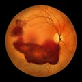Vitreous hemorrhage as observed during ophthalmoscopy, illustration