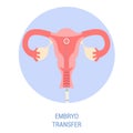 In vitro fertilisation step. Placing embryo into woman uterus.