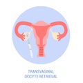 In vitro fertilisation step. Removing oocyte from the ovary Royalty Free Stock Photo