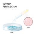 In vitro fertilization. artificial insemination Royalty Free Stock Photo