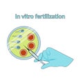 In vitro fertilization. Detailed infographic showing laboratory fertilization of eggs. Vector flat style