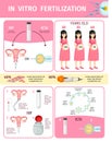 In Vitro Fertilization Infographic Concept Royalty Free Stock Photo