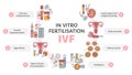 In Vitro fertilization IVF vector circle infographic and infertility treatment