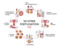 In Vitro fertilization IVF vector circle infographic and infertility treatment Royalty Free Stock Photo