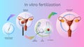 In Vitro Fertilization Procedures Vector Scheme