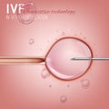 In Vitro Fertilization Royalty Free Stock Photo