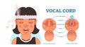 Vocal cord anatomy vector illustration diagram, educational medical scheme. Royalty Free Stock Photo