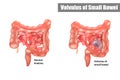 Volvulus of Small Bowel. Vector illustration