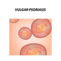 Vulgar psoriasis. Not pustular type of psoriasis. Eczema, skin disease dermatitis. Infographics. Vector illustration on Royalty Free Stock Photo