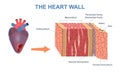 Wall heart structure