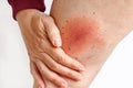 Wandering flush Lyme borreliosis of the leg of a woman transmitted by a tick Royalty Free Stock Photo