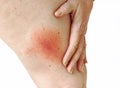 Wandering flush Lyme borreliosis of the leg of a woman transmitted by a tick Royalty Free Stock Photo