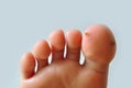 Wart on feet Royalty Free Stock Photo