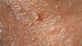 Wart on face. Macro shot of wart near eye. Papilloma on skin
