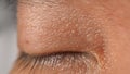 Wart on face. Macro shot of wart near eye. Papilloma on skin