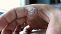 Wart on finger after treatment by salicylic acid. wart on the finger verruca freeze concept blurred neutral background