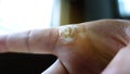 Wart on finger after treatment by salicylic acid. wart on the finger verruca freeze concept blurred neutral background Royalty Free Stock Photo