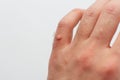 Wart on fnger man hand hand on white background Royalty Free Stock Photo