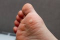 Wart on the foot. Plantar wart on the foot Royalty Free Stock Photo