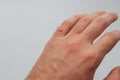 Wart on hand finger on white background