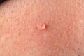 Wart on human skin