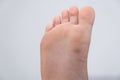 wart, papilloma on a feet. Macro shot, selective focus, close-up, space for text. Dermatological problems with the skin Royalty Free Stock Photo