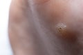 wart, papilloma on a feet. Macro shot, selective focus, close-up, space for text. Dermatological problems with the skin Royalty Free Stock Photo