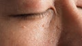Wart skin removal. Macro shot of warts near eye on face