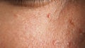 Wart skin removal. Macro shot of warts near eye on face