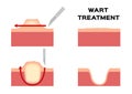 Wart treatment . remove it from skin by surgery callus