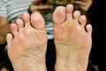 Wart under foot can treatment by salicylic acid Royalty Free Stock Photo
