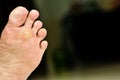 Wart under foot can treatment by salicylic acid Royalty Free Stock Photo