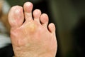 Wart under foot can treatment by salicylic acid Royalty Free Stock Photo