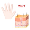 Warts on a hand. cross section of detailed wart