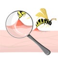 Wasp sting human. Close up detailed with magnifier pathogenesis of bee stings and allergic reaction. Vector illustration in Royalty Free Stock Photo