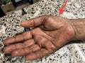 Wasting or Atrophy of Thenar Eminence Palm Muscles of in Asian, Burmese Female Elderly Patient. Caused by Carpal Tunnel Syndrome