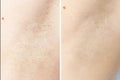 Waxing cosmetic depilation procedure results before after armpit