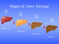 Stages of liver damage, liver disease. Healthy, fatty, liver fibrosis and cirrhosis on blue background.Vector illustratio