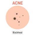 Blackhead skin acne type