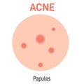 Papules skin acne type