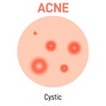 Cystic skin acne type