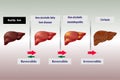 Stage disease of the liver , arrows indicate reversible and irreversible stages