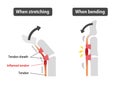 Trigger finger causes and symptoms illustration