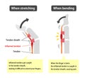 Trigger finger causes and symptoms illustration