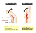 Trigger finger causes and symptoms illustration