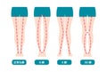 Difference types of legs angles and knees vector illustration . Normal, Bowlegs, Knock-knees. Royalty Free Stock Photo